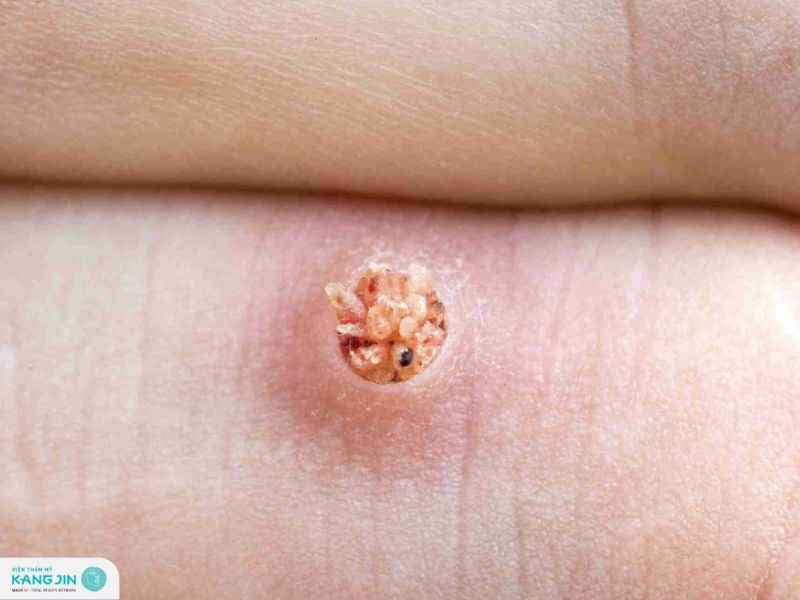 cách trị mụn cóc