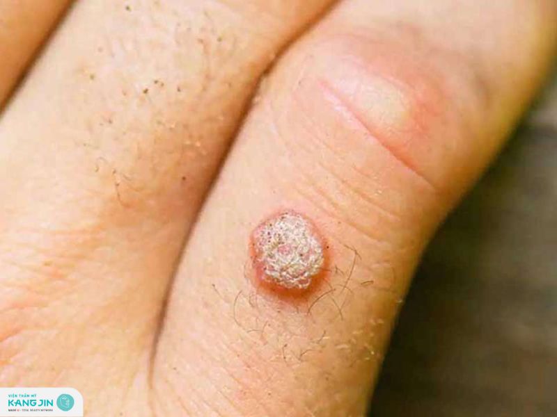 cách trị mụn cóc