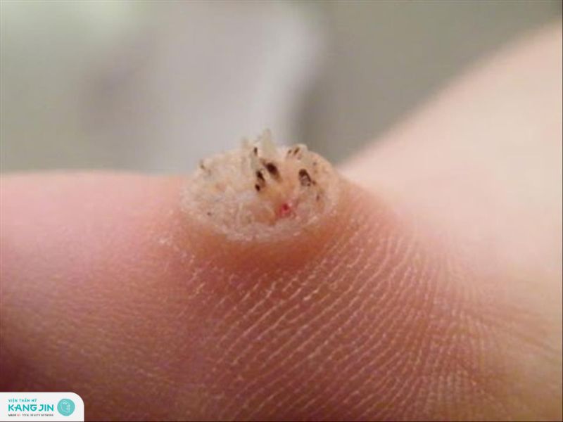 cách trị mụn cóc