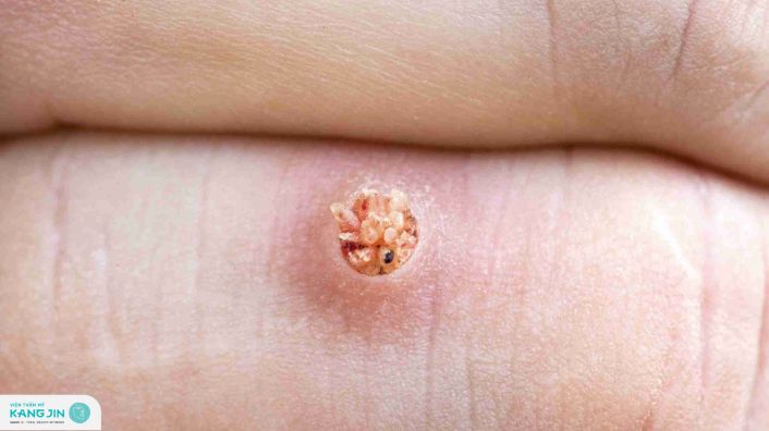 cách trị mụn cóc