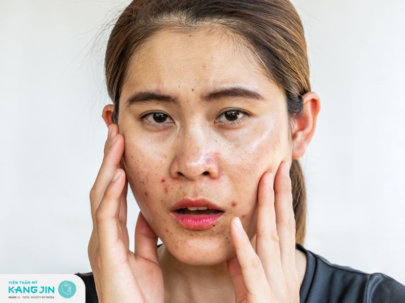 Tiêu chí chọn kem dưỡng ẩm cho da dầu 