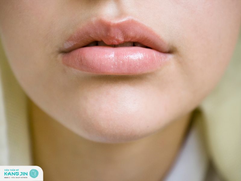 trị thâm môi