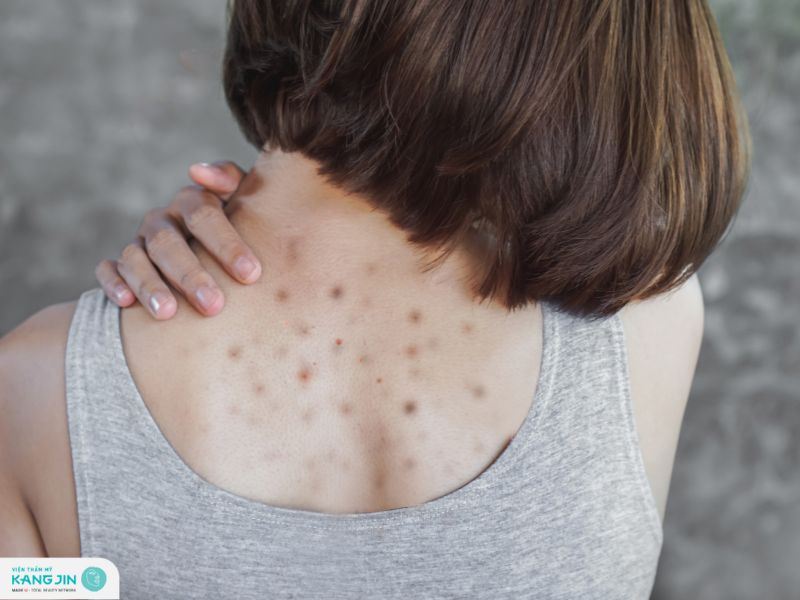 trị thâm mụn lưng