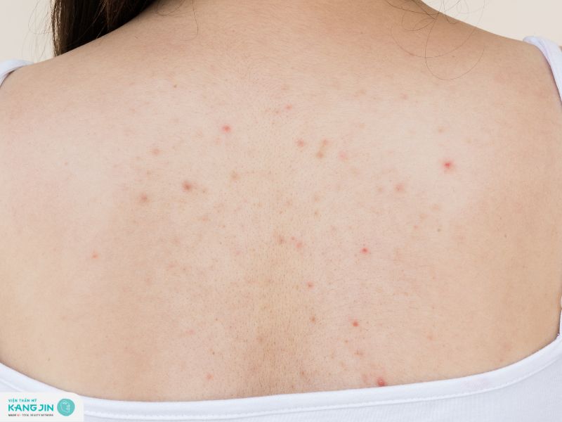 trị thâm mụn lưng