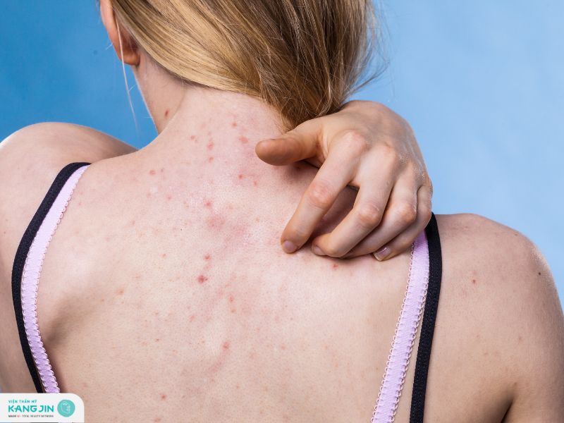 trị thâm mụn lưng