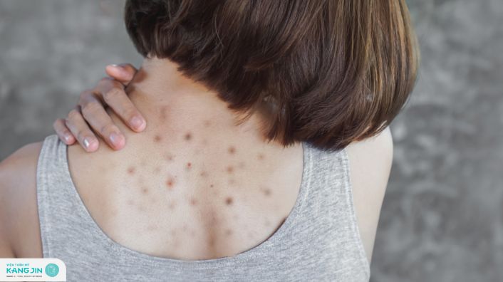 trị thâm mụn lưng