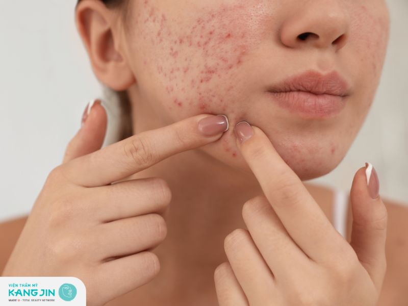 trị thâm mụn