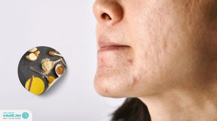 Cách trị sẹo thâm bằng nguyên liệu tự nhiên