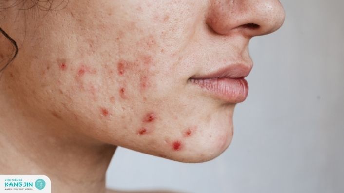 Mẹo xử lý dị ứng da bị mụn nhanh chóng kịp thời