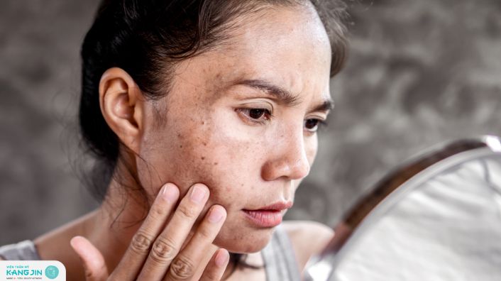 nguyên nhân gây nám tàn nhang