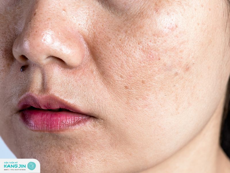 nguyên nhân gây nám tàn nhang