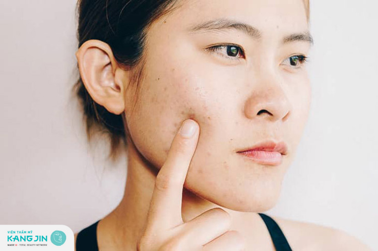 Rất nhiều nguyên nhận khiến da mặt xuất hiện vết thâm