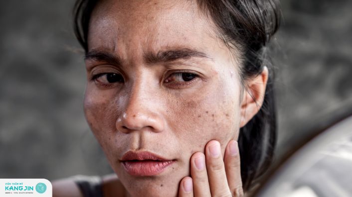 Sạm da mặt có nguy hiểm không? 8 Lưu ý khi trị sạm da tại nhà