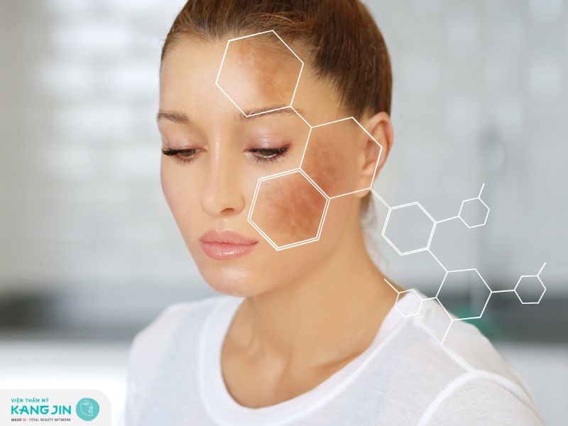 Sạm da mặt có thể có nguy cơ đối với thẩm mỹ và sức khỏe