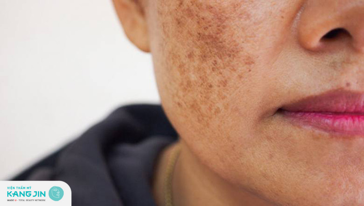 Cách trị vết thâm trên mặt