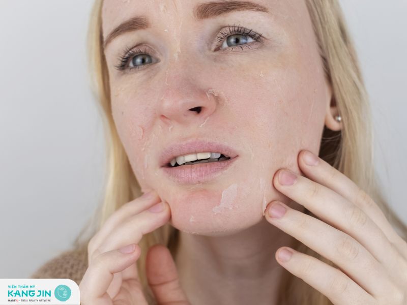 Tổng hợp các cách hết nẻ mặt hiệu quả