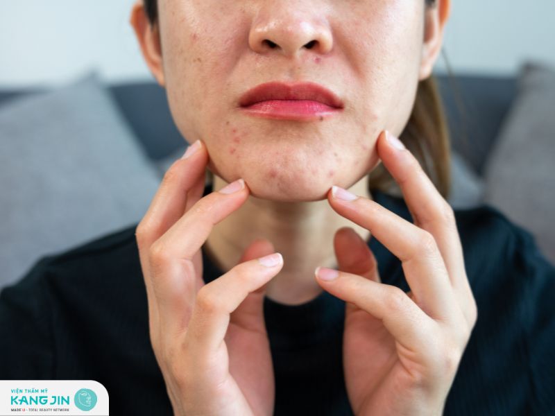 Hướng dẫn cách chăm sóc da dầu mụn tại nhà