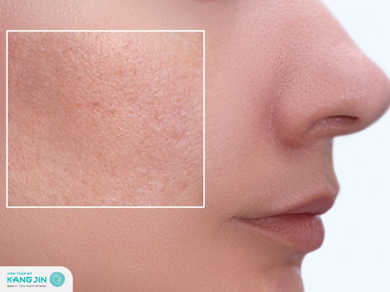 Sử dụng BHA giúp làm sạch sâu lỗ chân lông, ngăn ngừa mụn hình thành hiệu quả