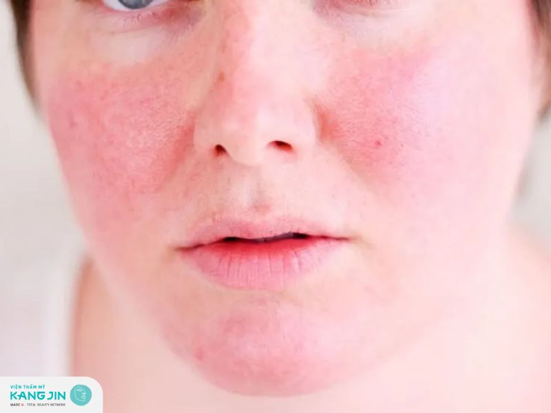nguyên nhân da mỏng đỏ