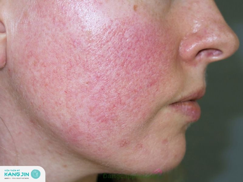 phục hồi da mỏng đỏ