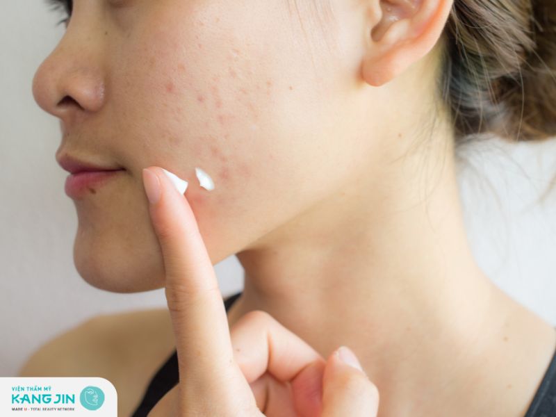 Sử dụng các sản phẩm kem bôi đặc trị để giảm thâm sau khi nặn mụn