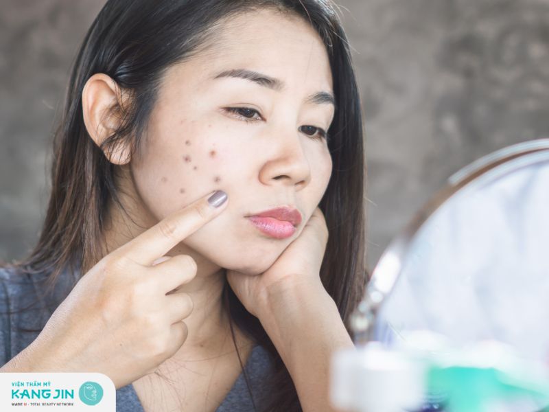 Trị thâm sau nặn mụn