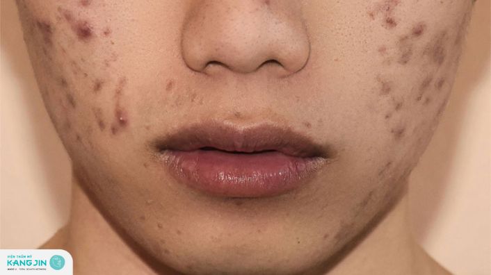 Cách trị thâm lâu năm cực tiết kiệm mà bạn cần biết