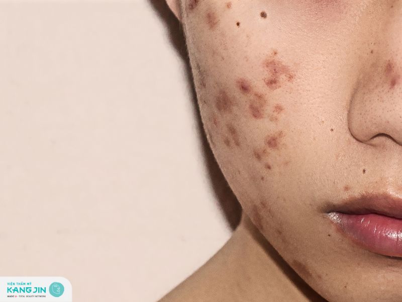 trị thâm lâu năm