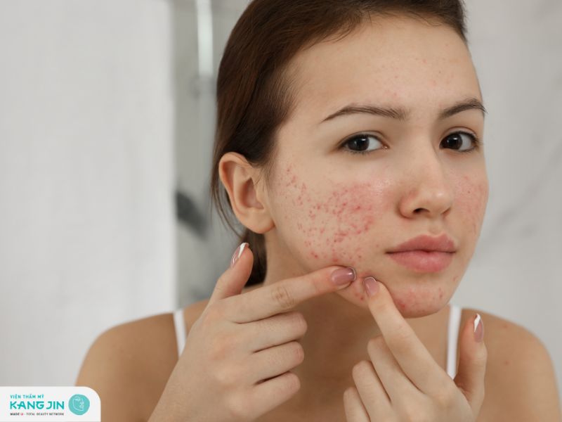 trị thâm lâu năm