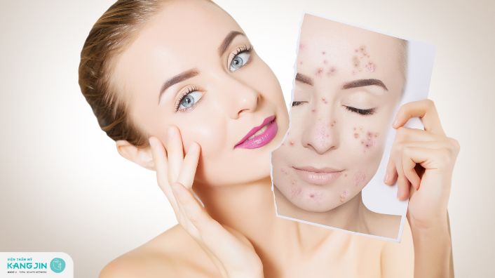 Cách trị thâm sau khi nặn mụn không để lại sẹo