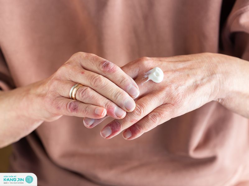 viêm da chảy nước vàng