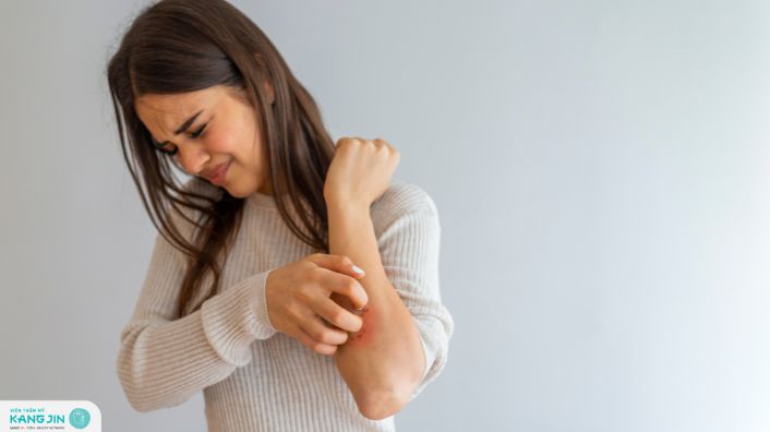 viêm da chảy nước vàng