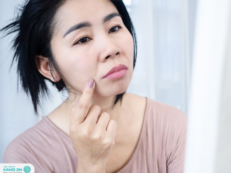 khắc phục rãnh cười sâu