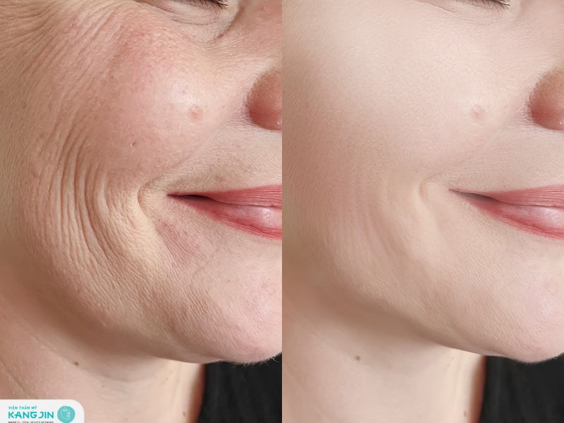 khắc phục rãnh cười sâu