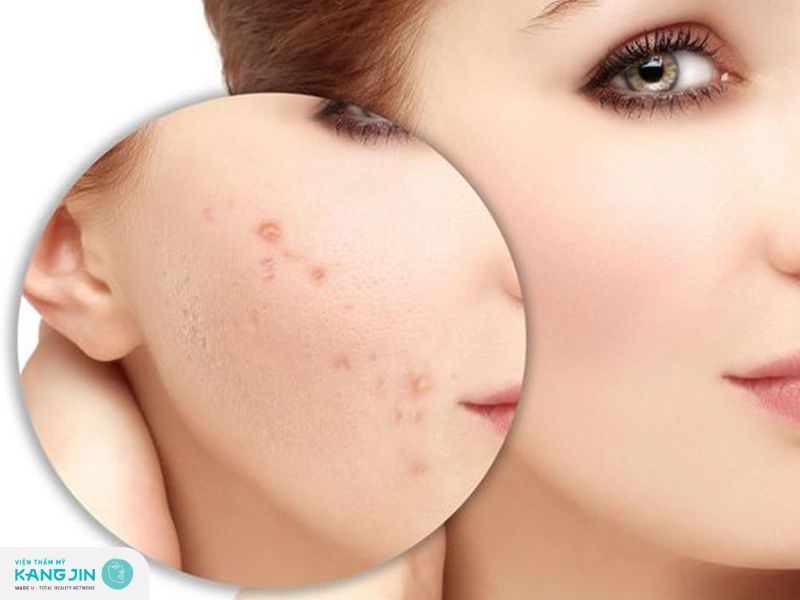 AHA trị thâm đỏ