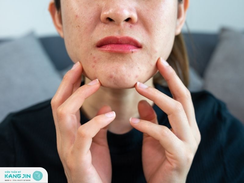 B5 có khả năng giảm thâm, cải thiện da thêm sáng khỏe