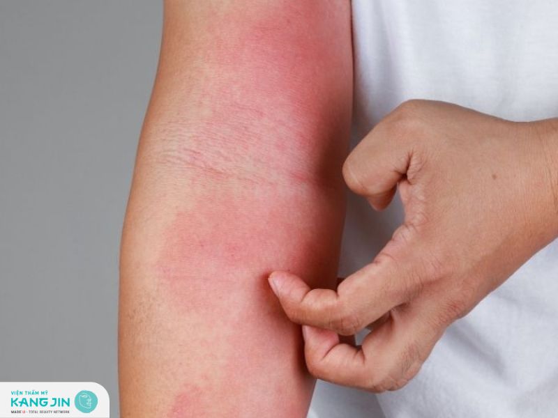 Các loại viêm da dị ứng thường gặp