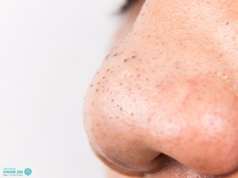 cách trị mụn đầu đen