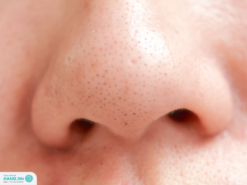 cách trị mụn đầu đen