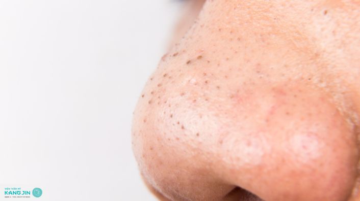 cách trị mụn đầu đen