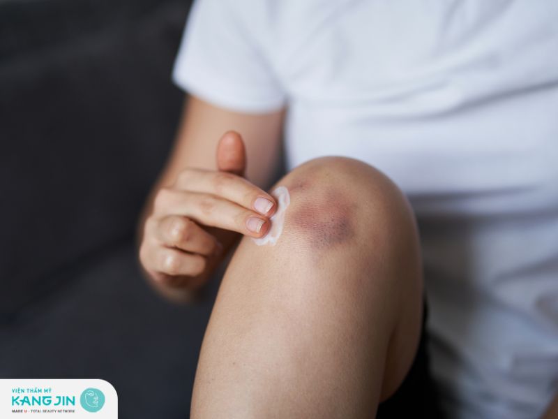 Sử dụng kem bôi đặc trị thâm đầu gối hiệu quả tại nhà 