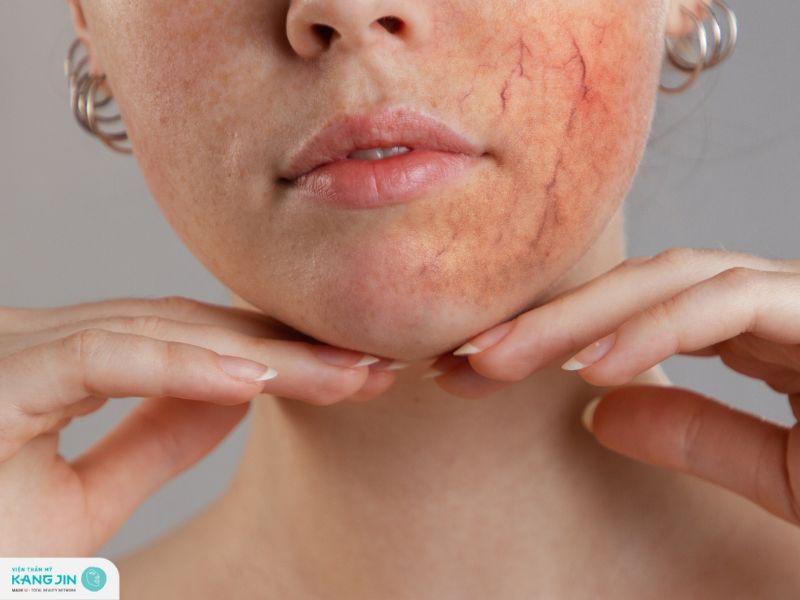 da mỏng nổi mao mạch