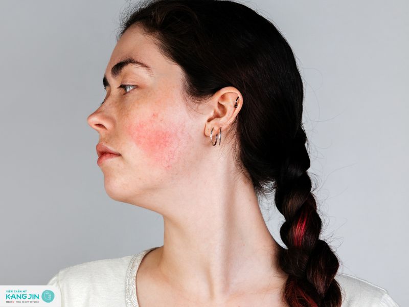 da mỏng nổi mao mạch