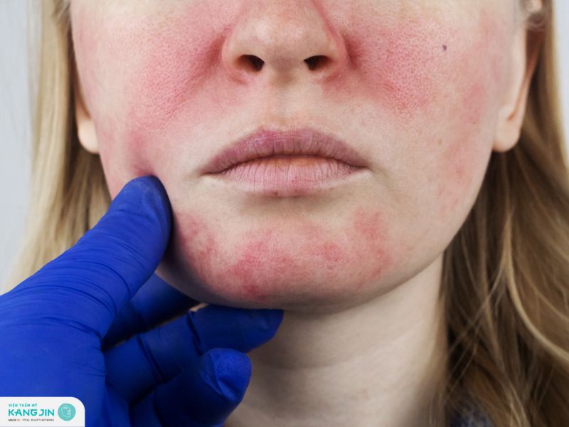 cách chăm sóc da bị lộ mao mạch