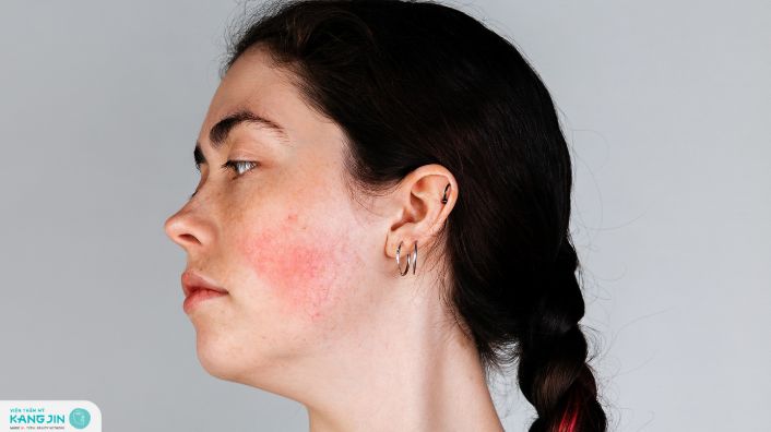 da mỏng nổi mao mạch