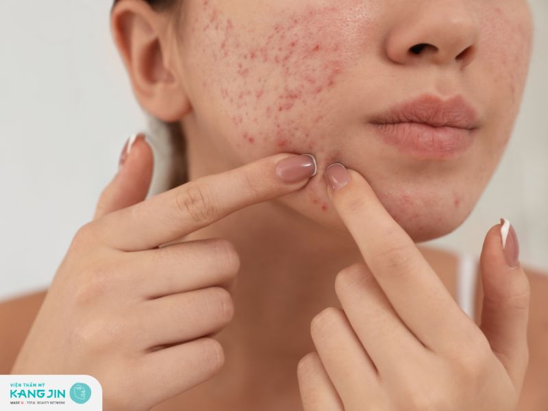 Đặc biểm nhận biết mụn ẩn với các loại mụn khác