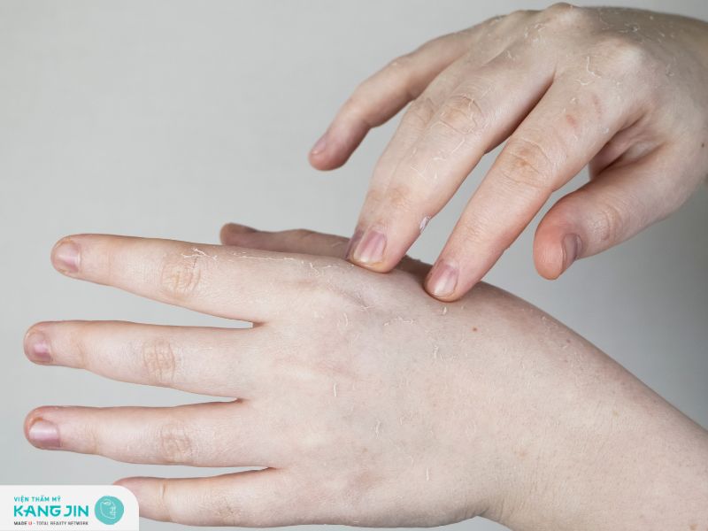 Sau peel, da có thể bị bong tróc và hết sau 3-7 ngày