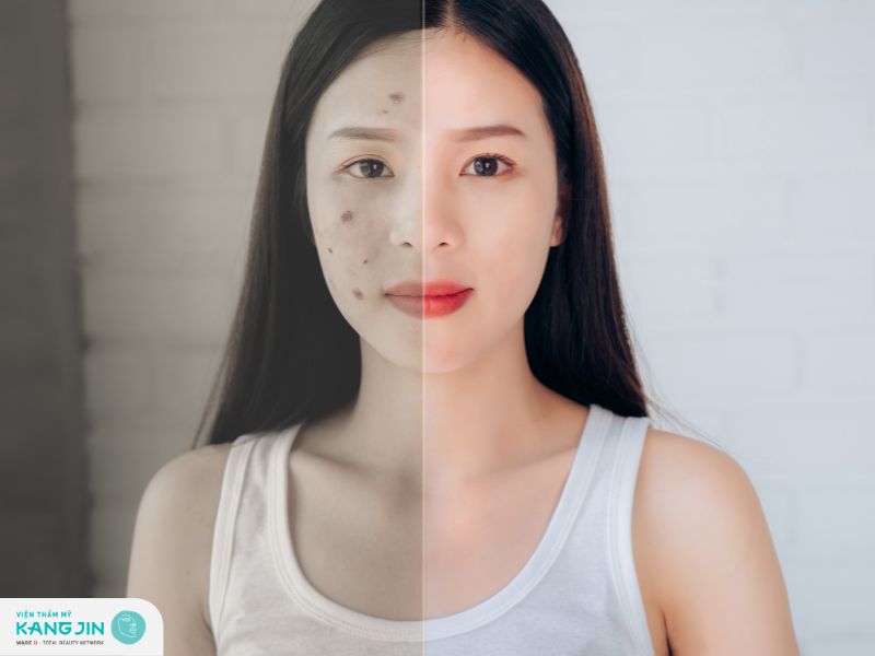 hoạt chất trị thâm mụn