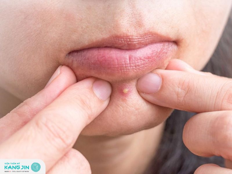 Mụn đinh: Nguyên nhân và cách khắc phục hiệu quả