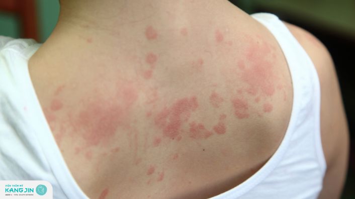 Nguyên nhân bị viêm da và cách chữa trị